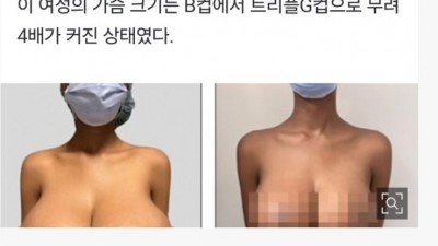 코로나 백신 맞고 유방 3배 커진 여성